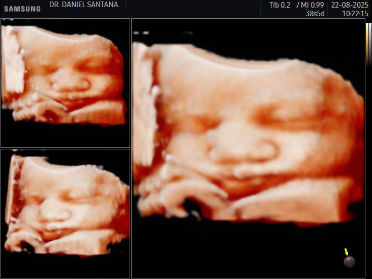 Ultrassom 3D real de bebê realizado pelo Dr. Daniel Santana